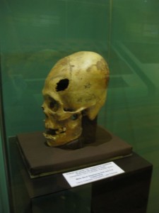 Reshaped skull showing a successful timpanum