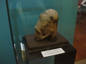 Scull shaped into a conical form during childhood by wrapping the head in ropes and cotton pads